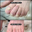 레푸스 울산점 | [울산남구 / 레푸스 울산 삼산점] 문제성발톱전문센터 <레푸스 울산 삼산점> 울산점 방문