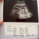 연세참한의원 | (난임극복17) 임신 17주차 증상 및 산부인과 정기검진 후기