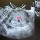 안녕?🌰 임신 초기 4주~7주 증상 및 일상(+다낭성 난소 증후군 한 번에 임신된 후기, 영양제, 생활습관)