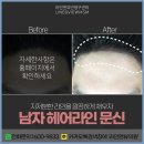 빈 헤어라인