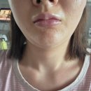 사후면세점 특화거리 | 압구정피부과 울쎄라프라임 &amp; 비비안 지방분해주사 솔직후기 (얼굴 라인 고민 해결!) 내돈내산