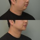 근육친구 | 30대 남자 이중턱 지방흡입+근육묶기 후기 [지흡 부작용, 효과] 1탄