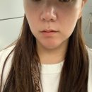 삼성동-9 | 붓기 통증 없는 온다리프팅 유지기간, 후기 삼성동 피부과