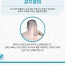 목 삐었을 때 목통증, 경추염좌 의심 (운동, 교통사고) 이미지