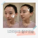 밝은얼굴피부과의원 | 신논현 피부과 쥬브아셀 스킨부스터 정품 확인부터 진행 과정