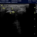 Tear within the triangular fibrocartilage 이미지