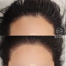 펑키파이브 | [공지] 송파 여자 헤어라인 반영구화장 여자 m자 이마 고민해결