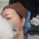 멍쥬 | [신사피부과] 엘라비에 리투오 후기, 효과, 가격, 멍, 부작용