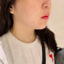 (주)진메디칼 | 부산 서면 온다리프팅 내돈내산 1개월차 솔직후기 비용 통증 시술시간 유지기간 총정리