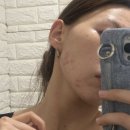 비움채뷰티아비스 | [노원피부관리] 비움채뷰티아비스에서 여드름관리 후기