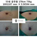 [남자유두축소수술전후] 53세 공무원 170cm 73kg 10X11X7 mm → 5.5X5X4 mm 이미지