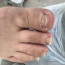 레푸스앤두두뷰티 | 의정부레푸스 고민하던 발톱 해결! 레푸스 앤 두두뷰티