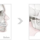 양악수술이나 하악수술 하고싶은 언니들 꼭 보세요! 이미지