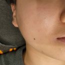 나날스킨 | [강남 논현피부관리] 내돈내산 슈퍼젝션 블랙 리프팅 나날스킨 후기