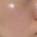 불행의 시작은 비교로부터 | 청담피부과 : 세렉소 포텐자펌핑팁 스킨부스터 후기!(모공, 건성고민)