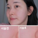 하트시그널 강유경 피부과시술 힐퓨전 받은 후기, 피부결시술 효과가 궁금했다면