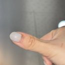 나도손톱 레푸스 개봉점 | 성인 수족구 후유증 손톱빠짐 3개월 경과 후기..