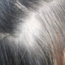 거창읍-13 | 거창두피 원형탈모 관리, 방치하면 더 커집니다 | 두피앤헤어 [시크릿바비뷰티 거창점]