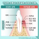 당뇨병과 밀접한 '치주질환' 원인과 예방·치료법은? 이미지