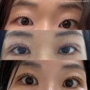 디에이치앤 | 무쌍 자연유착 쌍수 후기 (수술당일~11일차)(사진있음)