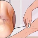 하지정맥류의 치료와 예방 이미지