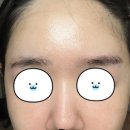 주사피부염 치료 과정들 적어봤어요 (주사피부염원인, 수란트라크림, 엘리델크림효과, 스테로이드연고부작용, 세레스톤지연고, 이버멕틴) 이미지
