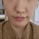 쉬즈애비뉴피부과의원 | 다산피부과 소프웨이브리프팅 후기｜30대 탄력 전후효과 통증 솔직리뷰