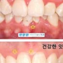 잇몸 부었을때 붓는 이유 아플때 관리 이미지