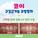 브레이스치과 | [코이 KOii 근기능교정장치] 과개교합 교정, 4개월 만에 달라진 변화 ✨
