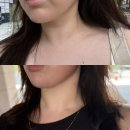 라인포인트주 | 압구정피부과 밴스슬림넥 효과 | 청담승모근보톡스 고민 끝 | 예비신부 목라인 관리 후기