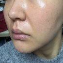 유정코피코주 | 모공 시술 포텐자 효과, 통증? 내돈내산 솔직후기(턱 보톡스+피코토닝)