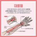 손목 혈자리 - 대릉(大陵)혈 이미지