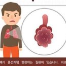 폐가 부풀어 오르는 질환 폐기종 증상 및 원인과 치료 이미지