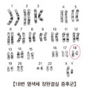 18번 염색체 장완결실 증후군 (18q monosomy)의 원인과 치료 이미지