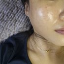 분당예쁨주의쁨의원 | [분당서현피부과] 필로드 시술 받기 전 꿀팁! 쥬베룩 맞아봤다면 이건 어때?