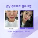 강남의원 | 강남역피부과 벨뷰의원에서 피부가 촉촉탱탱해진 날 , LDM 후기
