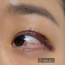 대망 | 대망의 쌍수 5~8일차 후기(돌출안, 무쌍, 매몰 쌍수 후기)