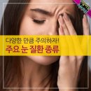 안구건조증 이미지