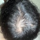 헤어로의원 | 전주 헤어로의원 모발이식 후 1년+관리꿀팁