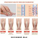 하지정맥류의 치료와 예방 | 하지정맥류 치료법 총정리 – 증상, 원인, 예방 및 수술 방법까지 (2025년 최신판)