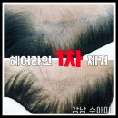 수아미인 | 두피문신제거 / 강남 수아미 두피문신제거 후기