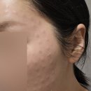 과천약국 | [내돈내산] 과천 유앤아이 피부과에서 리쥬란, 쥬베룩 볼륨, 인모드, 소노케어 후기