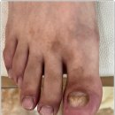 대구무좀발톱 깔끔하게 해결해준 네일,그대와 닥터아이티엔