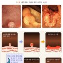 질병 수술비 특별약관에서 검사와 진단을 위한 생검을 한 경우 질병수술비 보험금을 지급하는지 여부 이미지