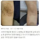 성연한의원 | 상동 물사마귀 치료 후기, 피부과에서 레이저 냉동 제거해도 재발? 전염될까 걱정인데, 가려움까지...