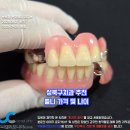 유씨캘리포니아치과의원(UC캘리포니아치과의원) | 성북구치과 유씨캘리포니아 추천 틀니가격 및 나이는?