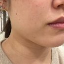 센텀5로 | 부산 센텀피부과 온다리프팅 이중턱 부위 6만줄 내돈내산 후기, 통증