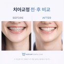 휴플란트치과의원 | 광주치과추천 성인 치아교정 비용·통증 현실 후기 총정리