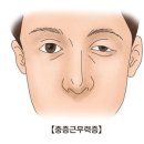 중증 근무력증[Myasthenia gravis]뇌신경정신질환 이미지