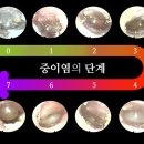 대학중앙약국 | 13개월 돌아기 중이염 대학병원 진료 후기